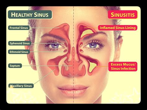 You become congested and have trouble breathing through your nose. . Sinus infection during two week wait